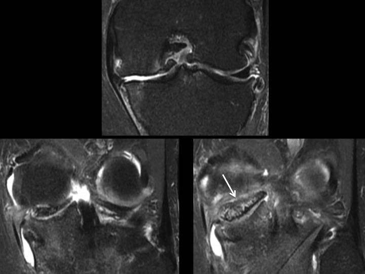 Figure 2 for case meniscal ossicle